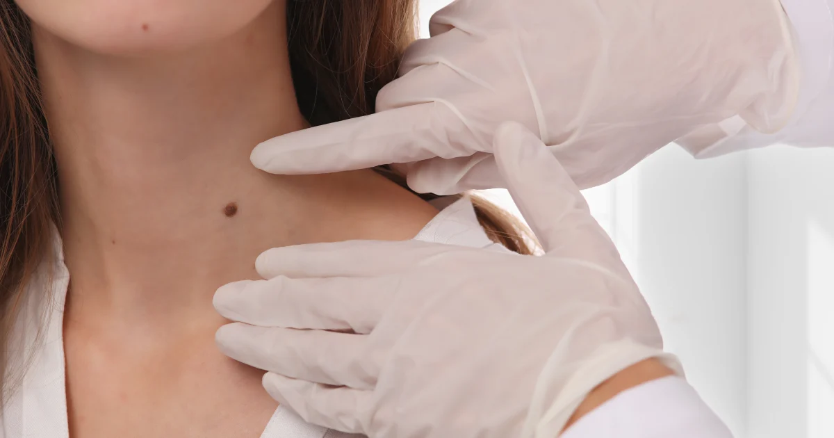 Patient receiving professional skin tag removal treatment with Hyfrecator-2000 in Greensboro, NC
