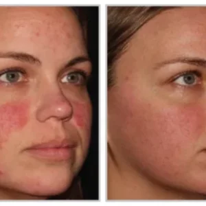 Before-after-hallo laser-epic-estetics-greensboro-NC