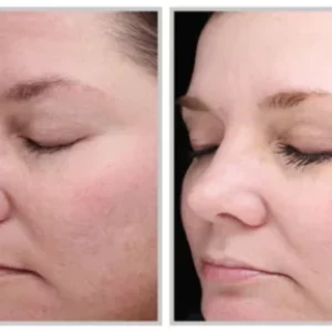 Before-after-halo laser-epic-estetics-greensboro-NC