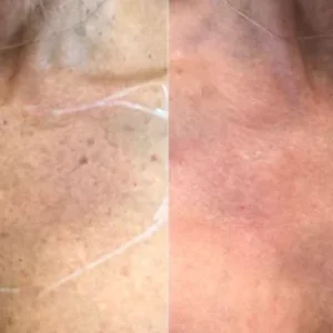 Beforee-after-bbl-photofacial-epic-estetics-greensboro-NC